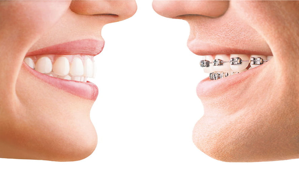 Are Invisalign Aligners Right for Your Smile Goals? at Amma Naana Dental Clinic